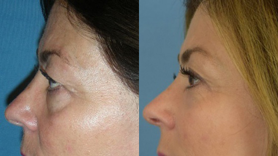 Female face, Eyelid Surgery Before and After treatment photo, l-side view patient 2