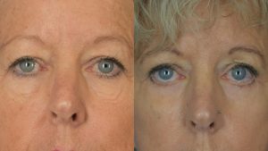  Female face, Eyelid Surgery Before and After treatment photo, front view patient 3
