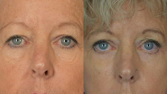 Female face, Eyelid Surgery Before and After treatment photo, front view patient 3