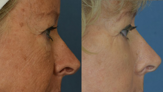 Female face, Eyelid Surgery Before and After treatment photo, r-side view patient 3