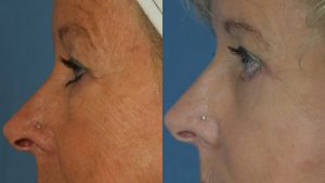  Female face, Eyelid Surgery Before and After treatment photo, l-side view patient 3