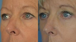  Female face, Eyelid Surgery Before and After treatment photo, l-side oblique view patient 3