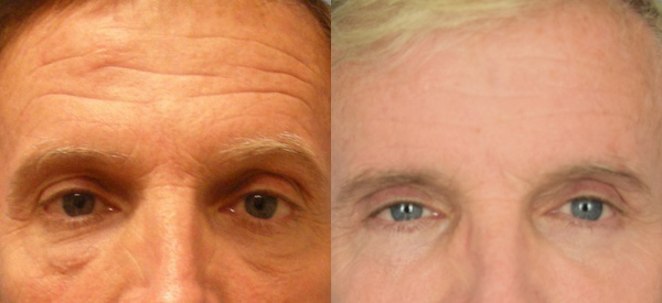 Male face, Eyelid Surgery Before and After treatment photo, front view patient 5