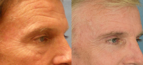  Male face, Eyelid Surgery Before and After treatment photo, r-side oblique view patient 4