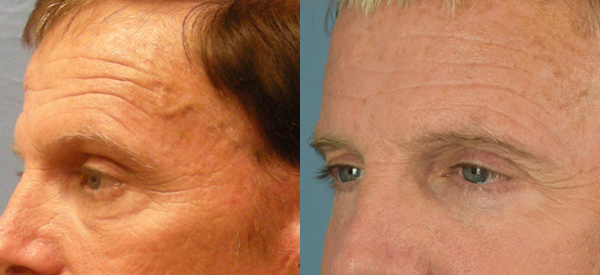 Male face, Eyelid Surgery Before and After treatment photo, l-side oblique view patient 5