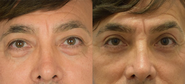 Male face, Eyelid Surgery Before and After treatment photo, front view patient 5