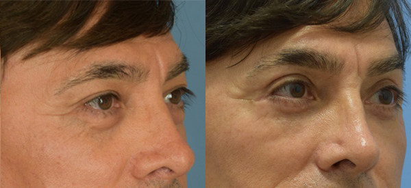 Male face, Eyelid Surgery Before and After treatment photo, r-side oblique view patient 5