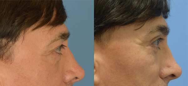 Male face, Eyelid Surgery Before and After treatment photo, r-side view patient 5