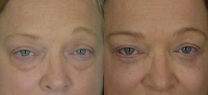  Female face, Eyelid Surgery Before and After treatment photo, front view patient 6