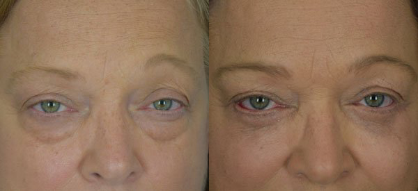 Female face, Eyelid Surgery Before and After treatment photo, front view patient 6