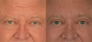  Male face, Eyelid Surgery Before and After treatment photo, front view patient 7