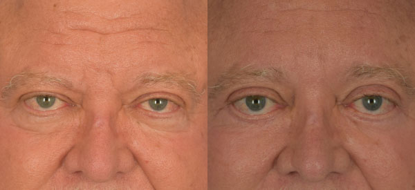 Male face, Eyelid Surgery Before and After treatment photo, front view patient 7