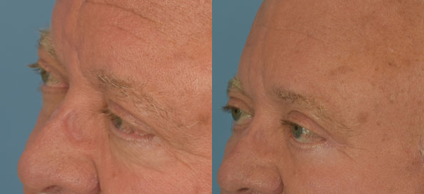 Male face, Eyelid Surgery Before and After treatment photo, l-side oblique view patient 7