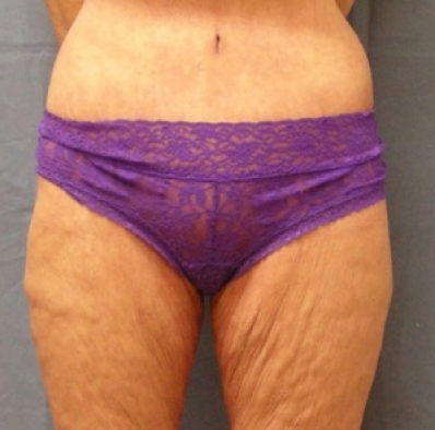 Female body, after Body Contouring treatment, front view