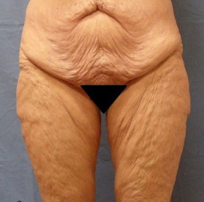 Female body, before Body Contouring treatment, front view