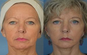  Female face, before and after facelift treatment, front view, patient 1