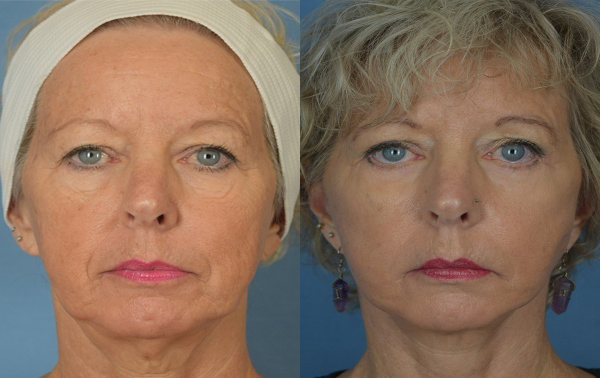 Female face, before and after facelift treatment, front view, patient 1