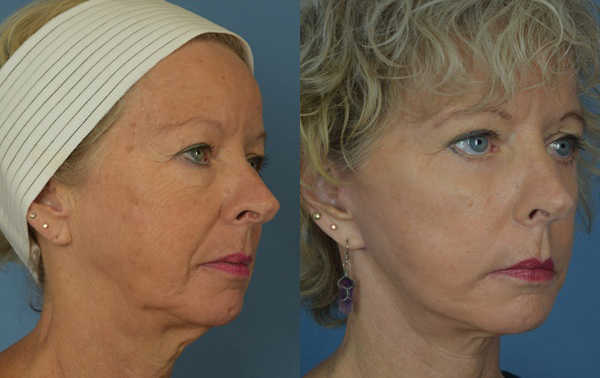 Female face, before and after facelift treatment, r-side oblique view, patient 1