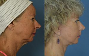  Female face, before and after facelift treatment, r-side view, patient 1
