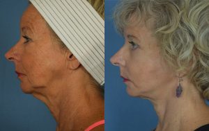  Female face, before and after facelift treatment, l-side view, patient 1