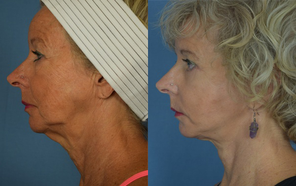 Female face, before and after facelift treatment, l-side view, patient 1