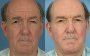  Male face, before and after facelift treatment, front view, patient 2