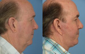  Male face, before and after facelift treatment, r-side view, patient 2
