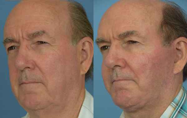 Male face, before and after facelift treatment, l-side oblique view, patient 3