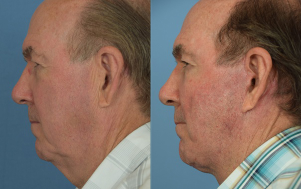 Male face, before and after facelift treatment, l-side view, patient 3
