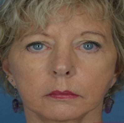 Female face, after Facial Rejuvenation treatment, front view