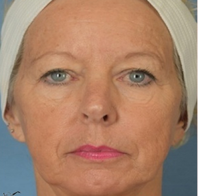 Female face, after Facial Rejuvenation treatment, front view