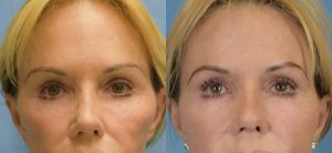  Female face, before and after Fat Transfer treatment, front view, patient 1