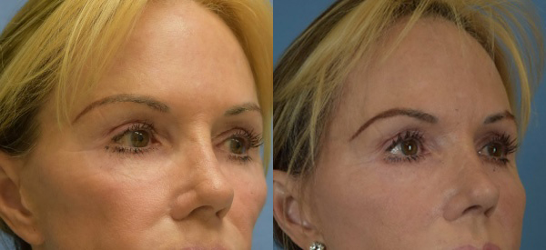 Female face, before and after Fat Transfer treatment, r-side oblique view, patient 1