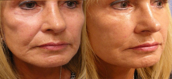 Female face, before and after Fat Transfer treatment, r-side oblique view, patient 2