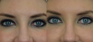  Female face, before and after Fat Transfer treatment, front view, patient 3