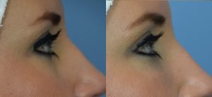  Female face, before and after Fat Transfer treatment, r-side view, patient 3