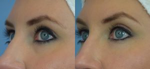  Female face, before and after Fat Transfer treatment, l-side oblique view, patient 3