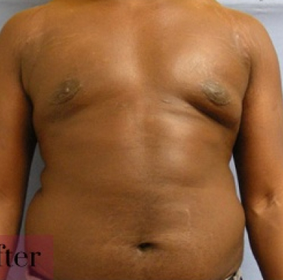 Male body, after Male Breast Reduction treatment, front view