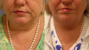  Female face, before and after Neck lift treatment, front view, patient 1