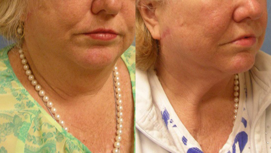 Female face, before and after Neck lift treatment, r-side oblique view, patient 1