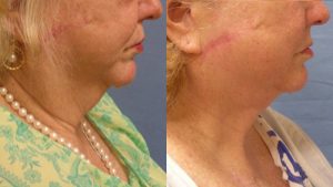  Female face, before and after Neck lift treatment, r-side view, patient 1