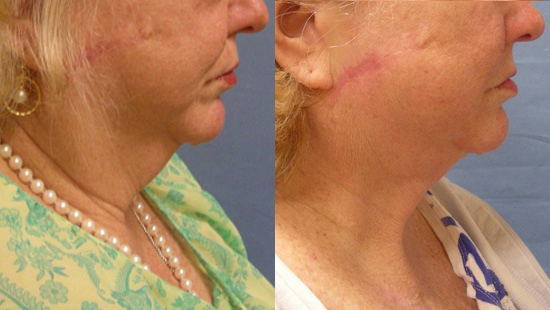 Female face, before and after Neck lift treatment, r-side view, patient 1