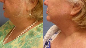  Female face, before and after Neck lift treatment, l-side view, patient 1
