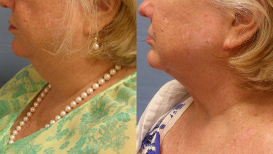 Female face, before and after Neck lift treatment, l-side view, patient 1