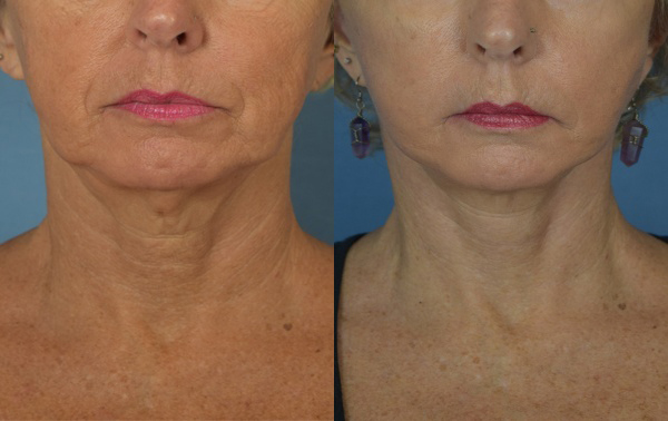 Female face, before and after Neck lift treatment, front view, patient 2