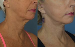  Female face, before and after Neck lift treatment, r-side oblique view, patient 2