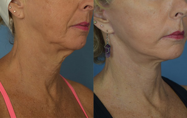 Female face, before and after Neck lift treatment, r-side oblique view, patient 2