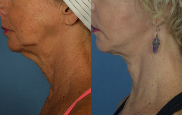 Female face, before and after Neck lift treatment, l-side view, patient 2