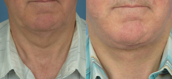 Male face, before and after Neck lift treatment, front view, patient 3