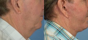  Male face, before and after Neck lift treatment, r-side view, patient 3
